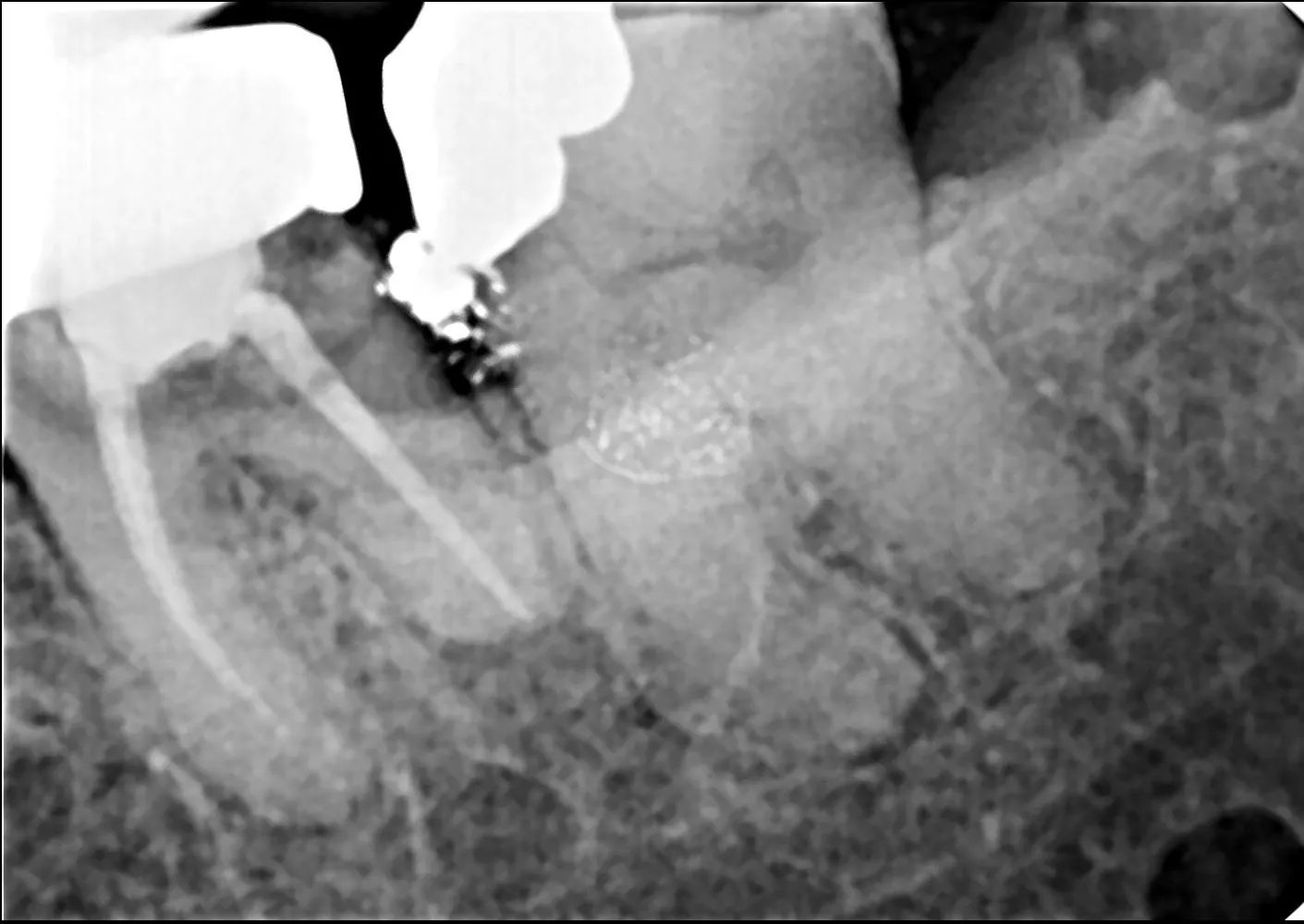 Is Wisdom Tooth Removal Painful? Dentist in Thane (Nitin Company Area) Explains the Truth