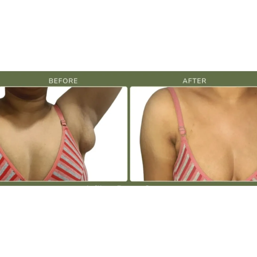 Axillary Breast (Accessary Breast) Treatment in Mumbai