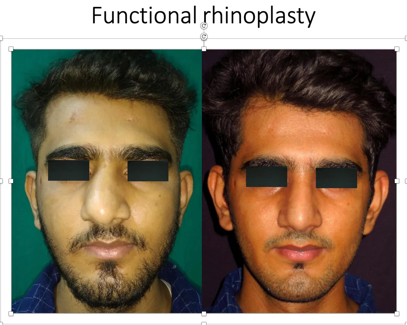 Celebrity Rhinoplasty in Mumbai | Expert Plastic Surgeon for Natural Nose Reshaping in Andheri