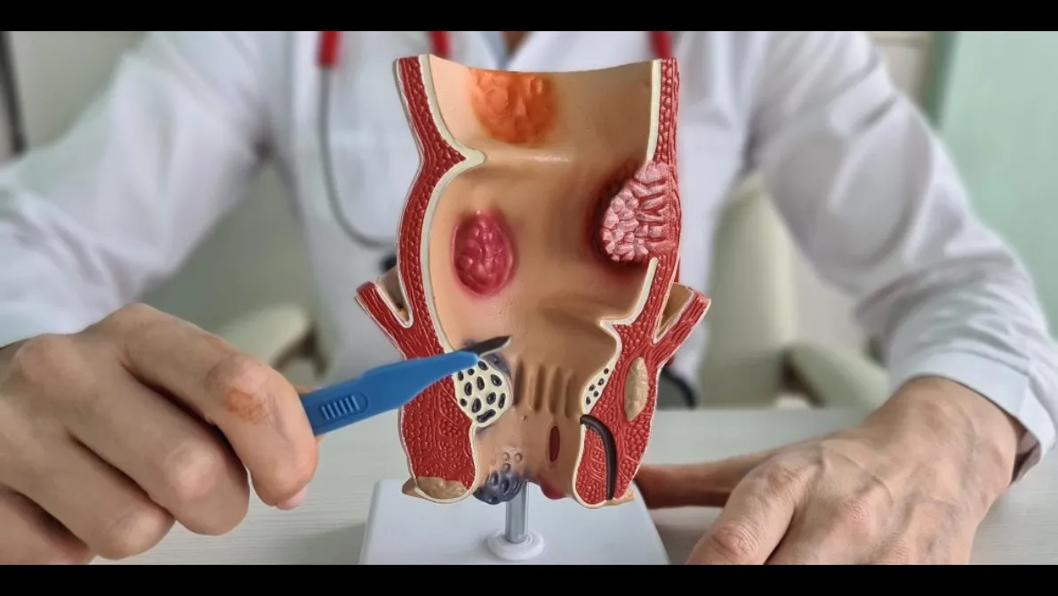 Fistula Surgery in Goregaon – Addressing a Persistent Concern with Clarity