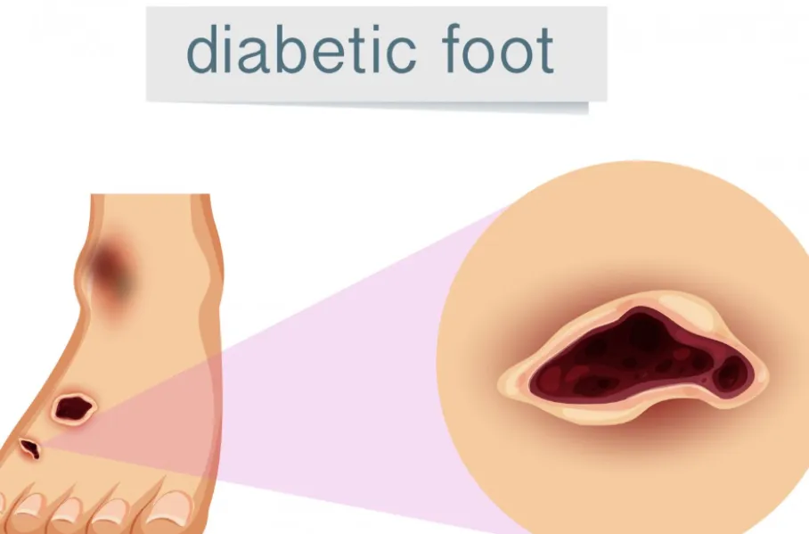 Diabetic Foot Surgery Expert in Chembur – Protecting Mobility Through Timely Care
