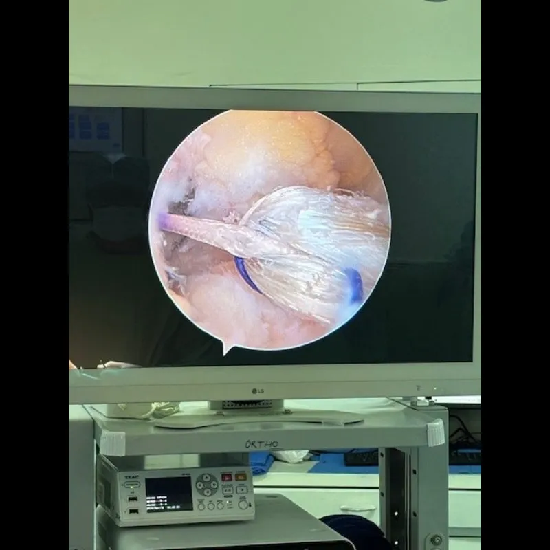 ARTHROSCOPIC ACL RECONSTRUCTION FOR YOUNG PATIENT