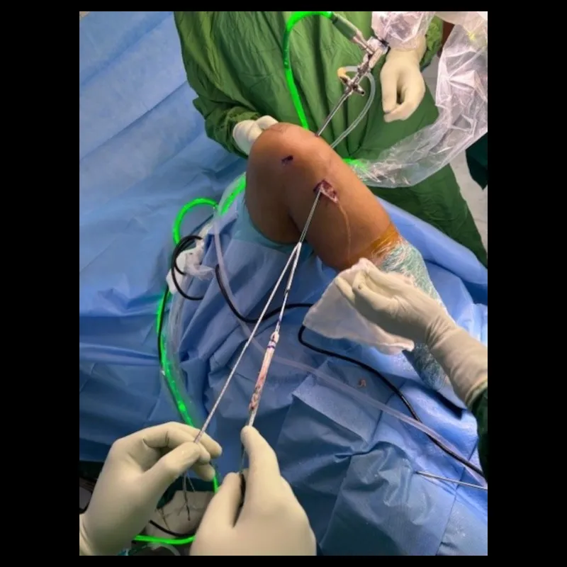 Arthroscopic ANTERIOR CRUCIATE LIGAMENT SURGERY done successfully By Dr Pankaj Kumar