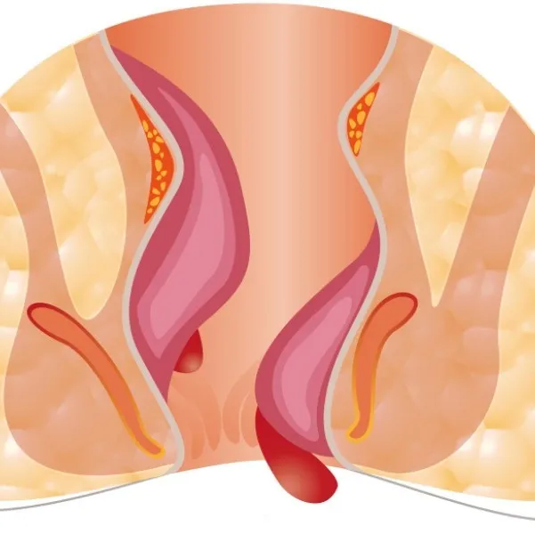Laser Treatment for Piles (Hemorrhoids) in Mumbai Central – A Modern and Less Painful Treatment Opti