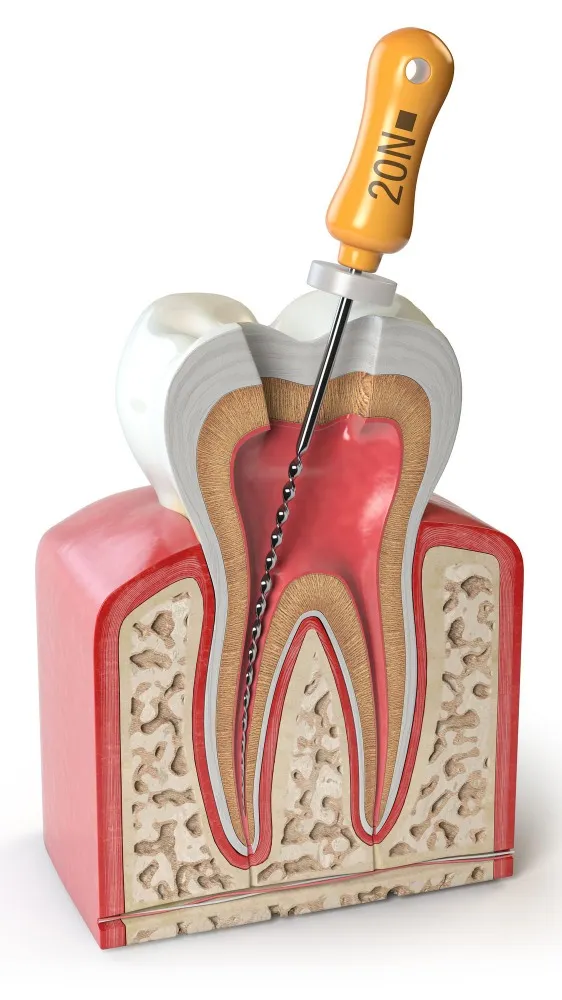 Root Canal Treatment in R.T Nagar - Preserving Natural Teeth with Modern Care