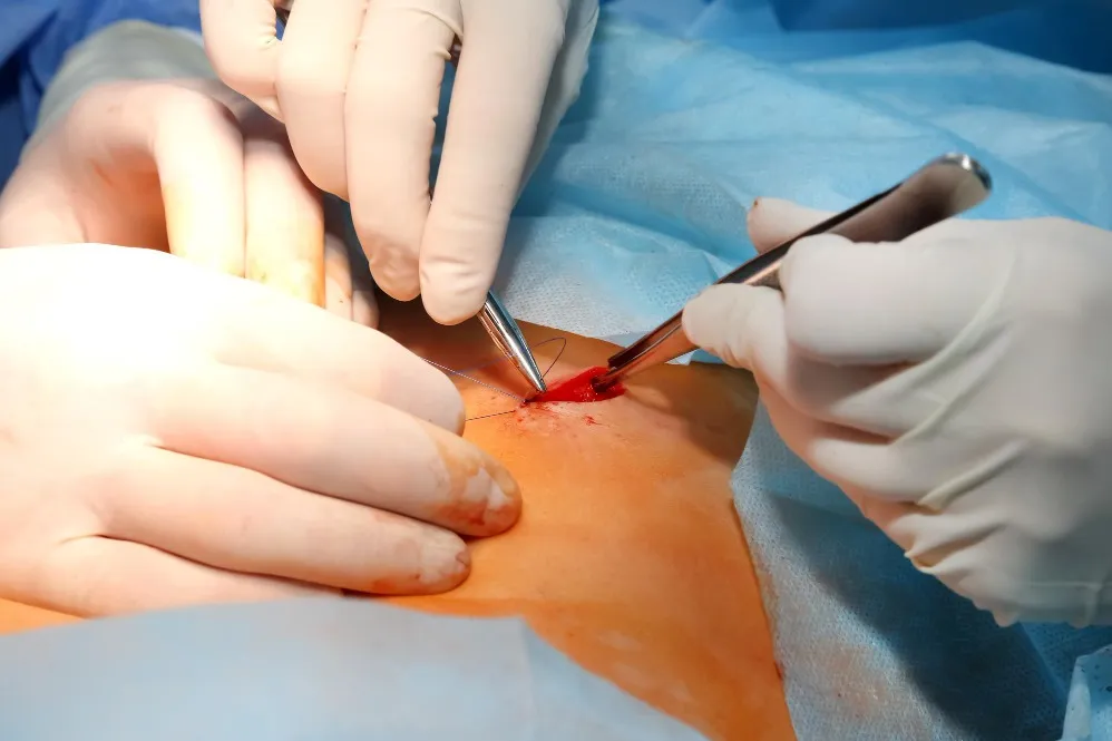 Cosmetic and Lipoma Removal Surgeon in Sion – Safe Excision with Minimal Scarring