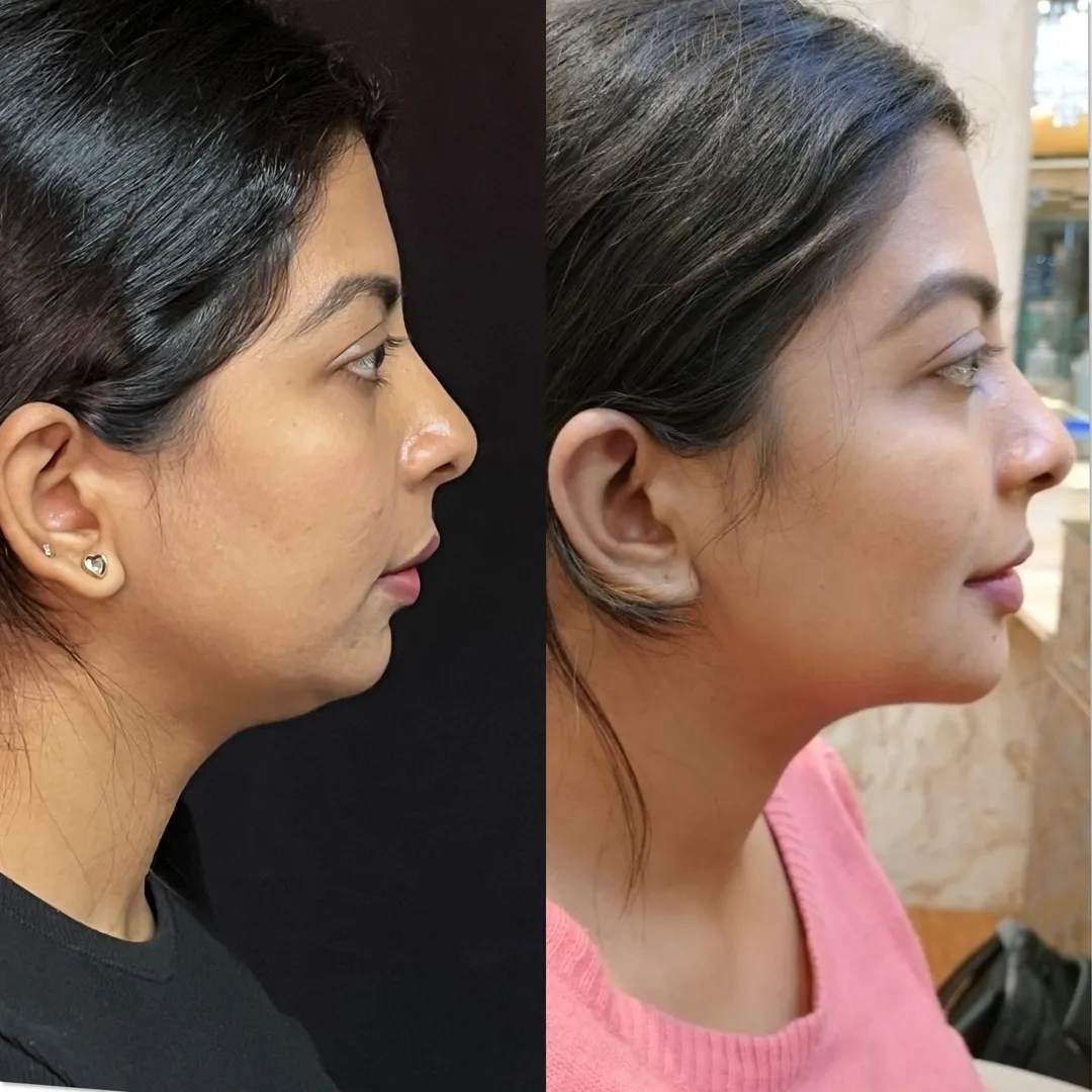 Jawline Contouring with Fillers & Double Chin Liposuction near me
