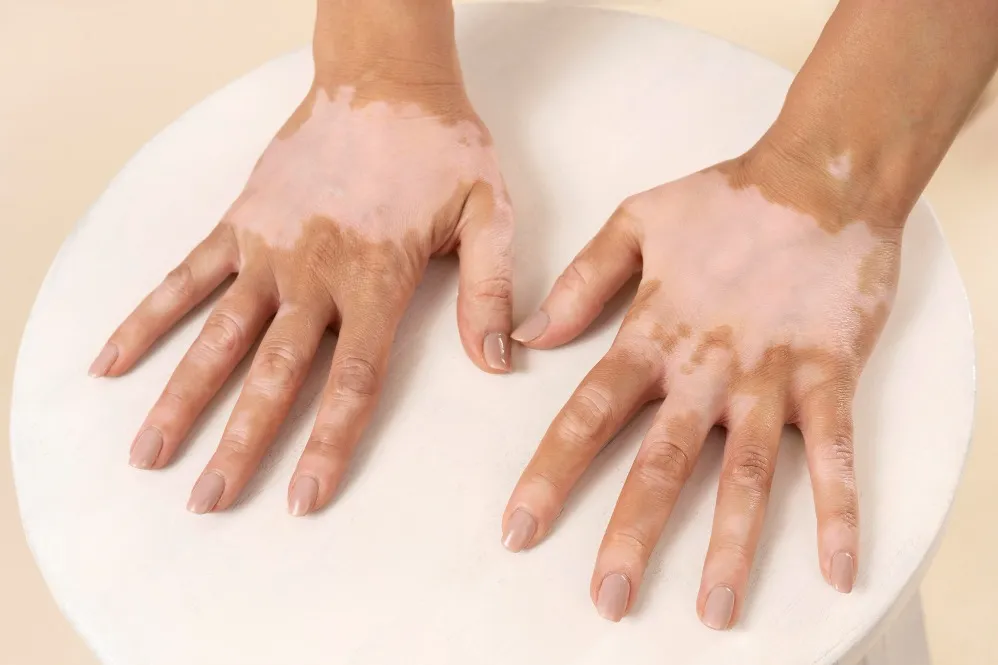 Vitiligo Treatment in Pune - Managing Skin Pigmentation Disorders