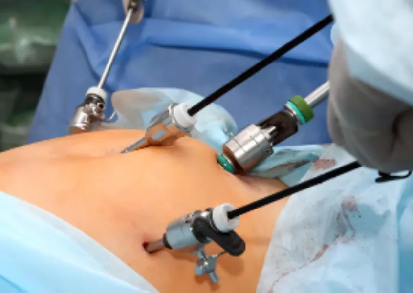 Precision and Faster Recovery with Minimally Invasive Laparoscopic Surgery in Nashik