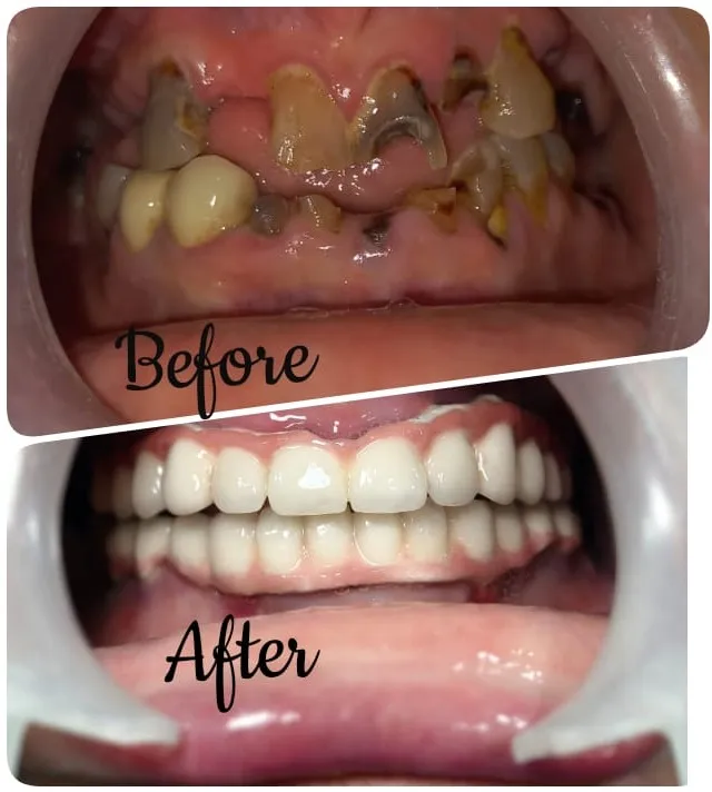 When Do You Need Full Mouth Rehabilitation? Signs Patients in Thane (Nitin Company Area) Should Not