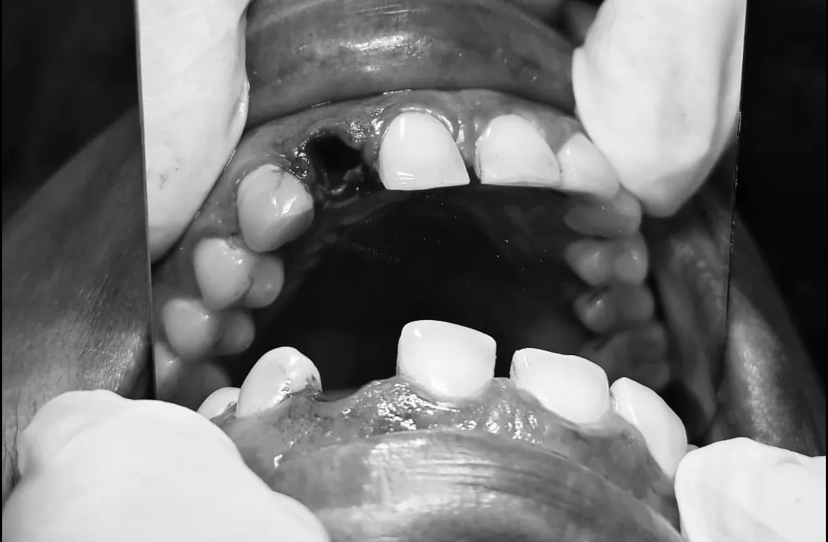 How Much Does Tooth Extraction Cost in Mulund West Mumbai? A Complete Patient Guide
