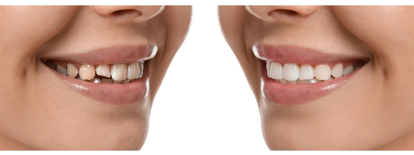 Smile Design Treatment in Sarjapur Road – Small Corrections That Transform a Smile