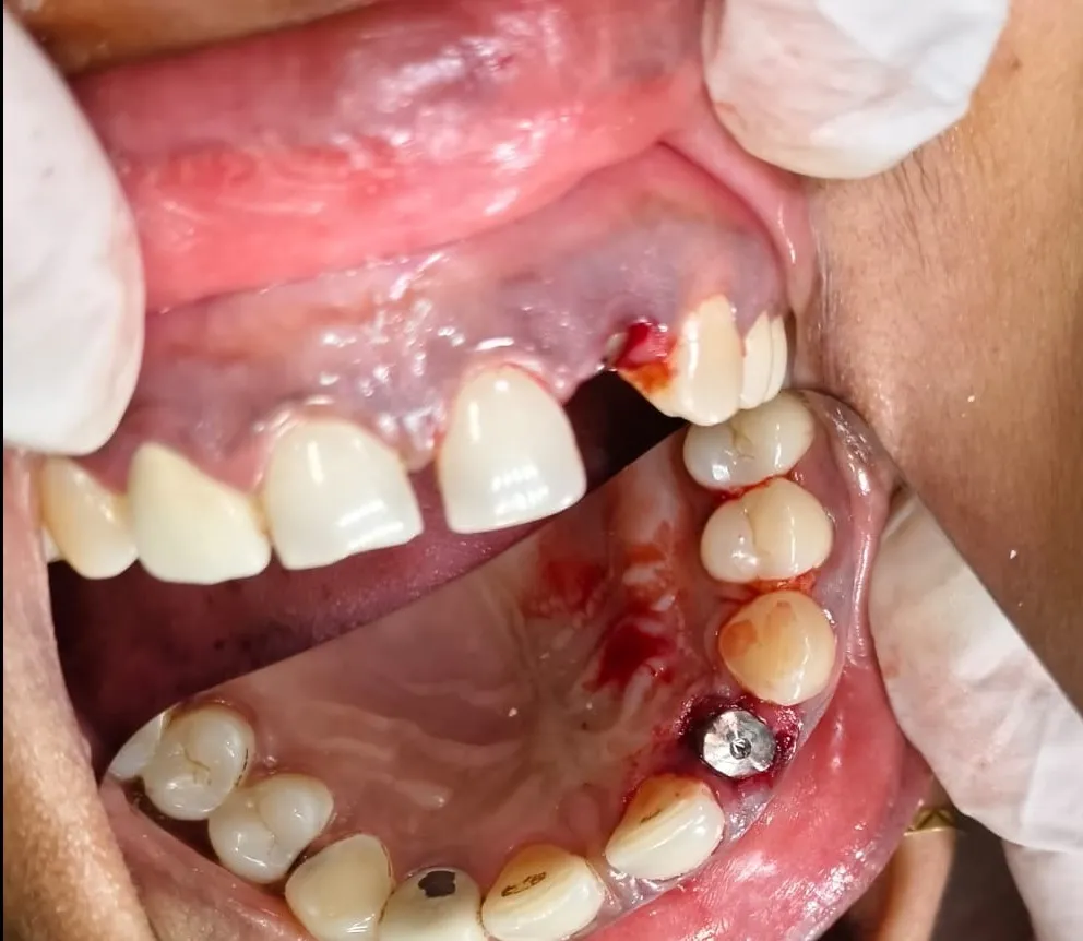 When Do You Need Dental Implants? Signs Patients in Mulund West Mumbai Should Not Ignore