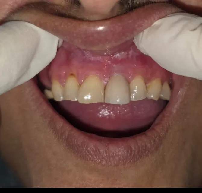 Is Dental Crowns Painful? Dentist in Mulund West Mumbai Explains the Truth