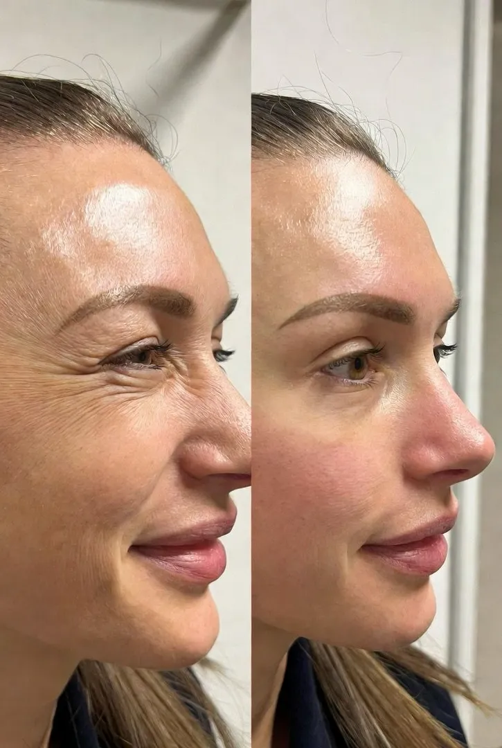 botox in nashik
wrinkles removal treatment
botox nashik
