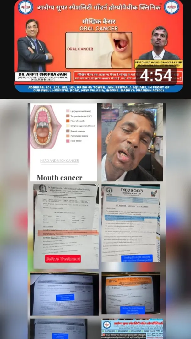 1 महीने में मुंह के कैंसर में सुधार Post operative Recurrence Case –Dr Arpit Chopra Jain Homoeopathy...
