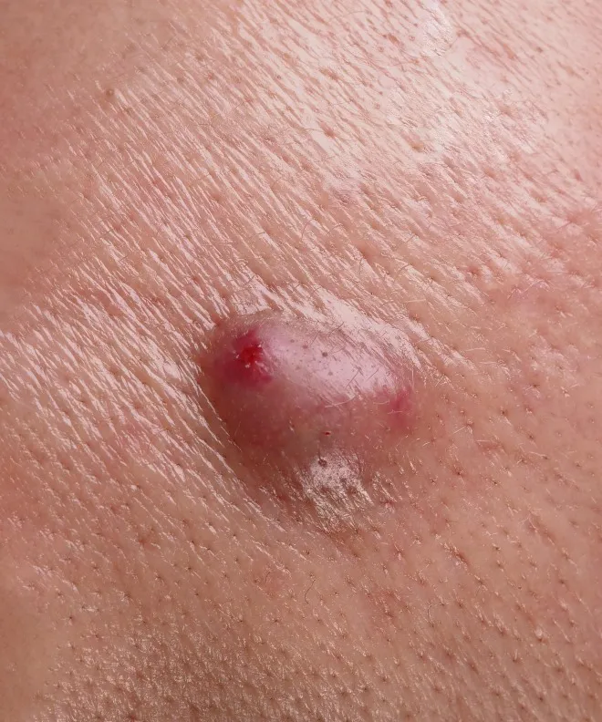 Sebaceous Cyst Surgery in Kolathur, Chennai - Complete Removal for Healthy Skin