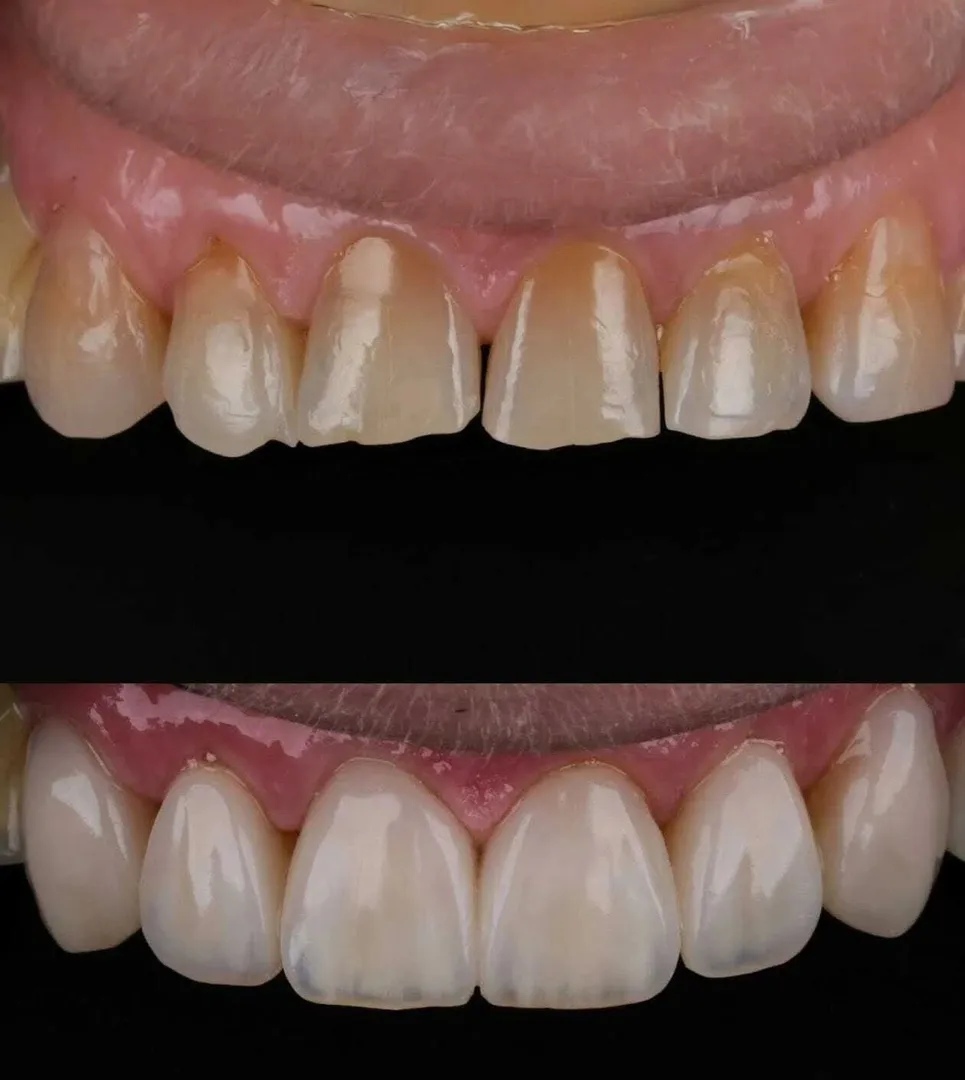 Dentist for Tooth Filling in Noida Extension | P.D. Dental Clinic