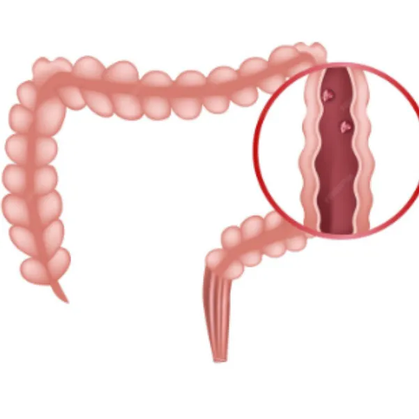 Colonic Polyps Treatment in Mumbai – Early Detection for Better Digestive Health