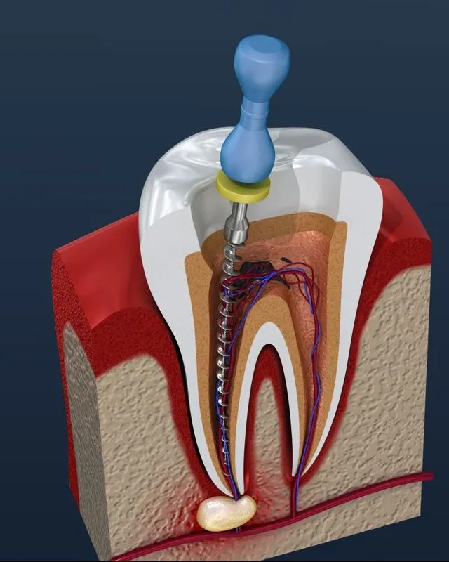 root canal treatment near me