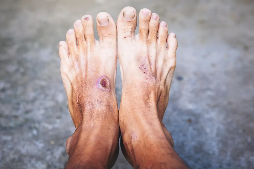 Diabetic Foot Treatment in Taloja Why Early Care Matters More Than You Think