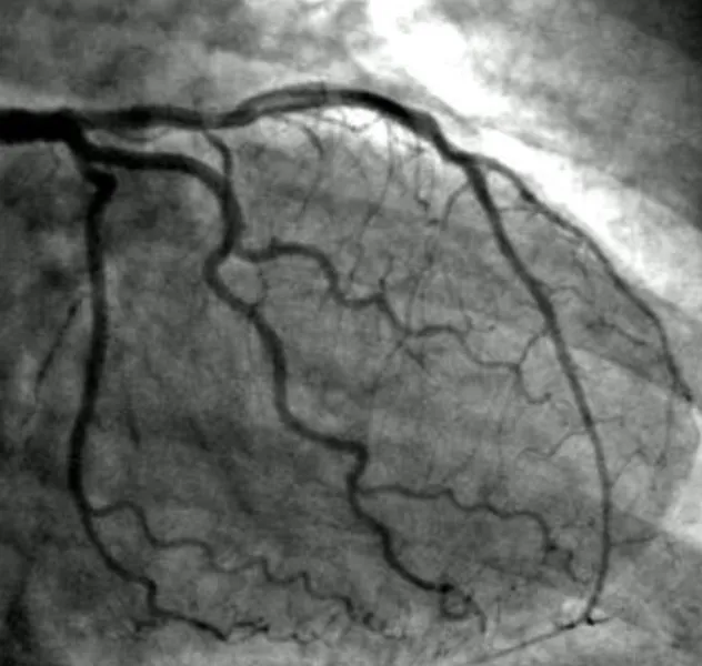 Angiogram Test in Bangalore for Accurate Coronary Artery Diagnosis