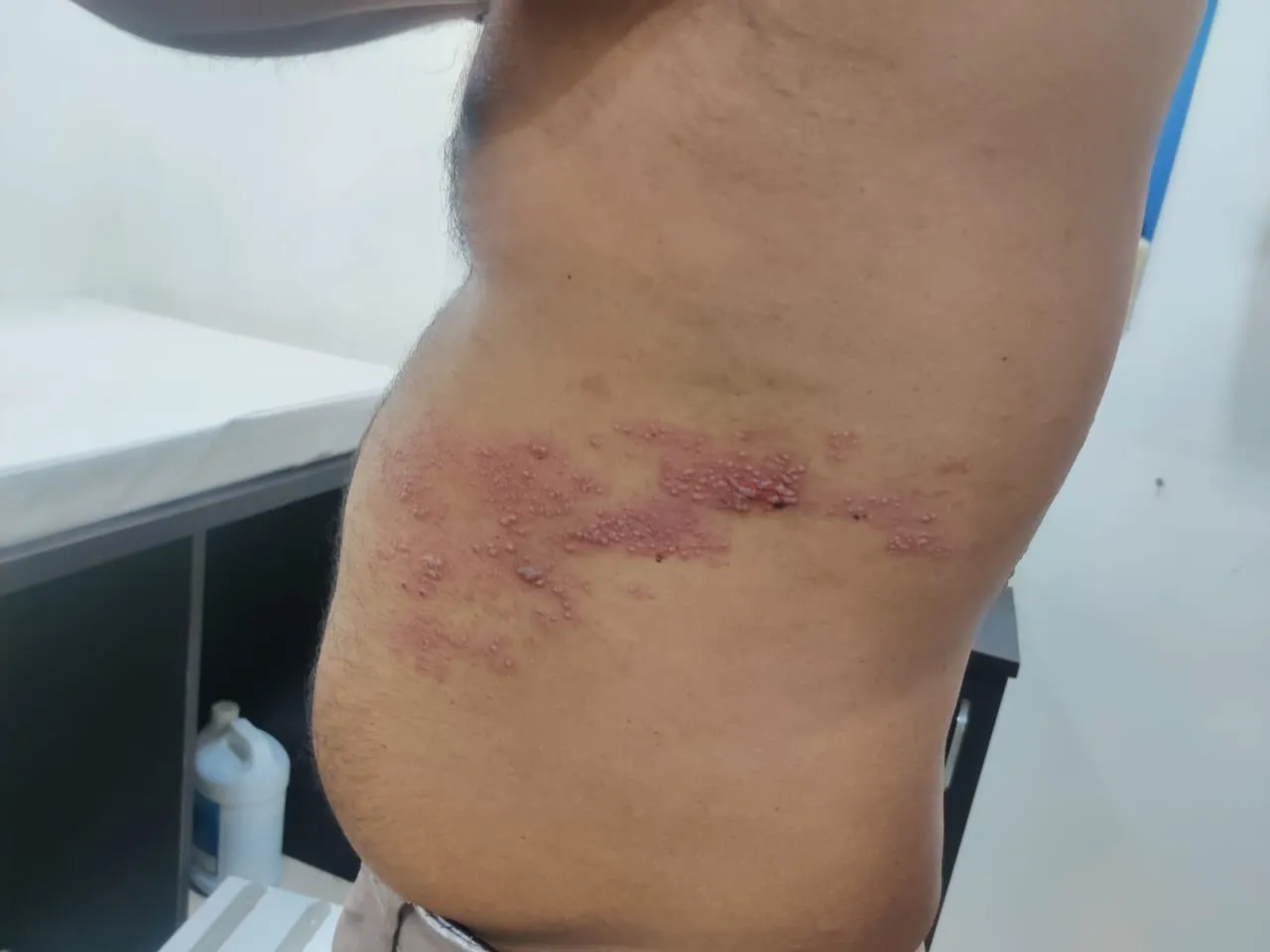 Postherpetic Neuralgia (PHN)