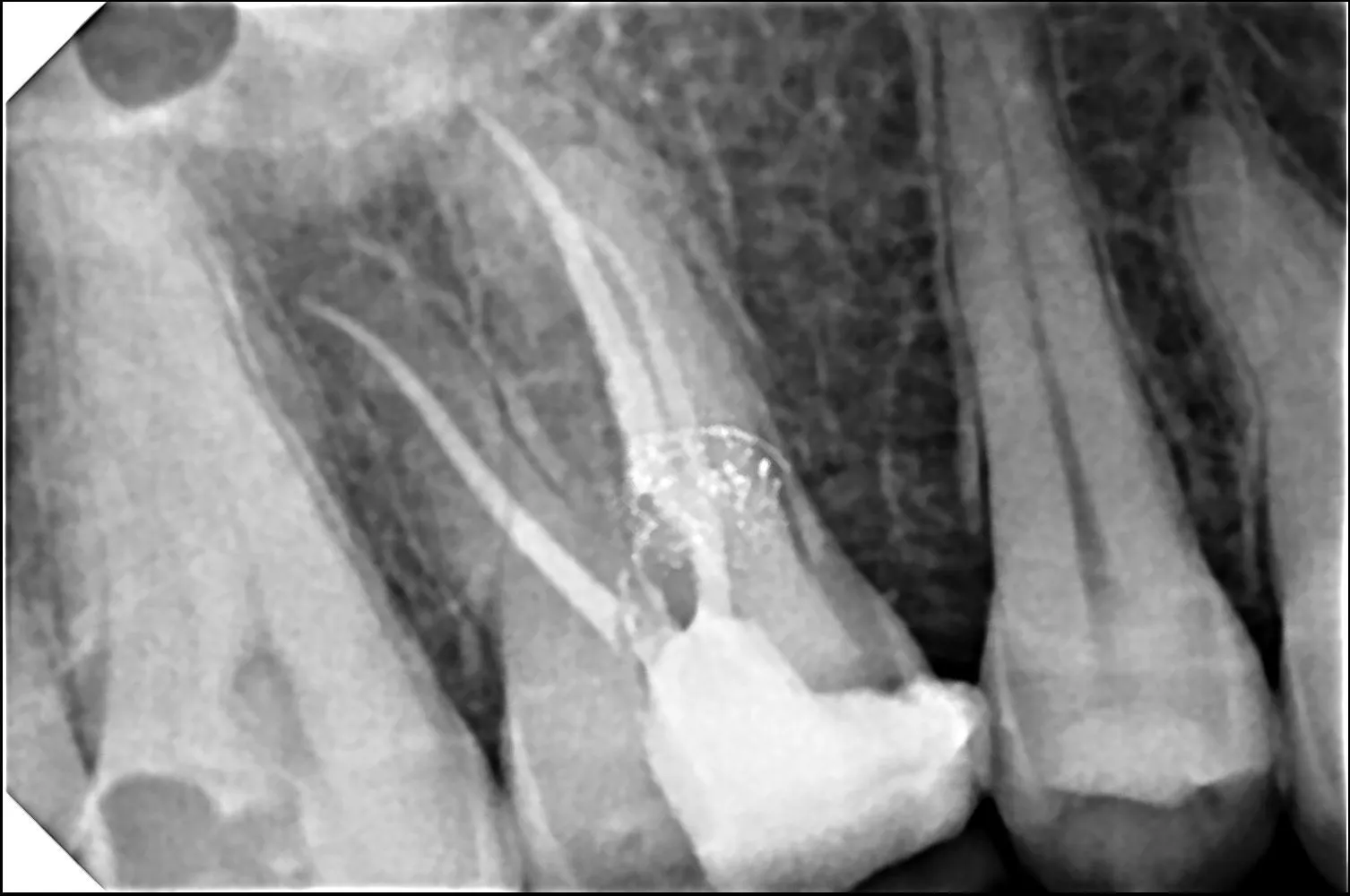 Tooth pain can disrupt your daily life & many patients searching for root canal treatment in Mulund