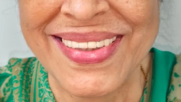 Full mouth rehabilitation is a comprehensive dental solution designed for patients with multiple den