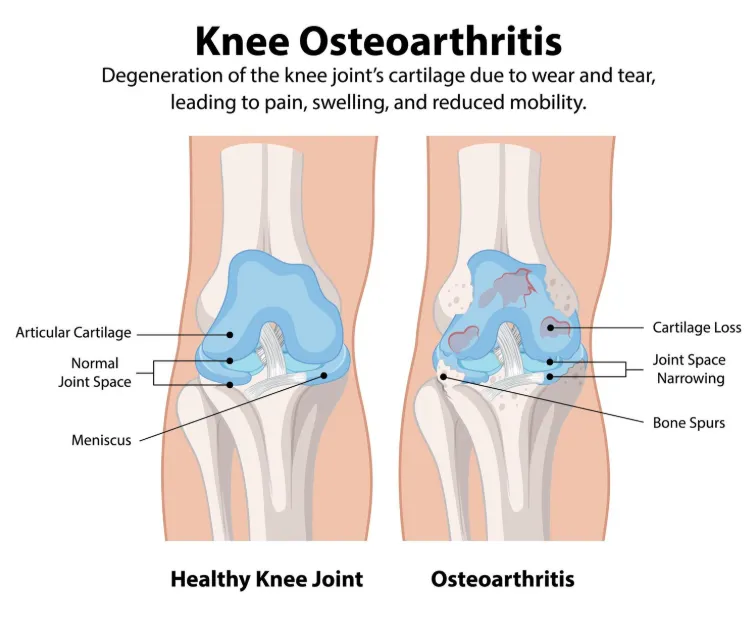 Osteoarthritis Knee Care in Delhi for Long Term Joint Comfort
