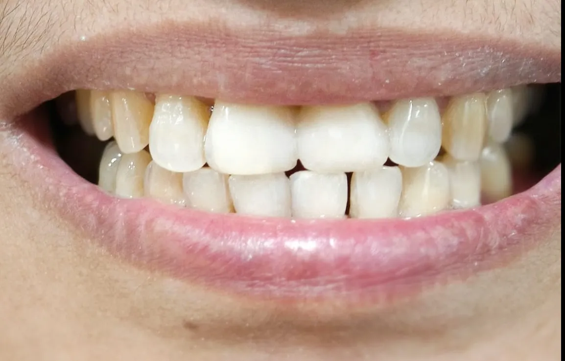 Is Smile Makeover Painful? Dentist in Mulund West Mumbai Explains the Truth