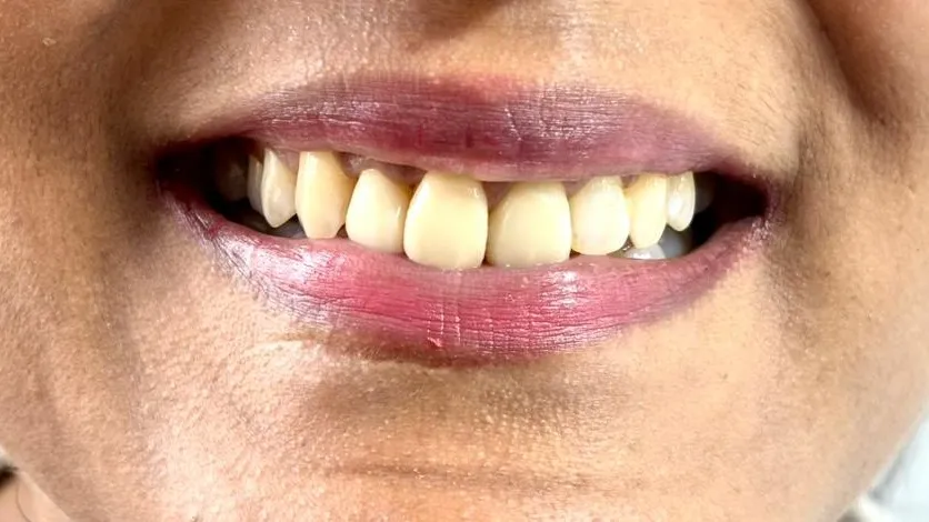 Dental Veneers in Thane (Nitin Company Area): Cost, Procedure & Recovery Time Explained