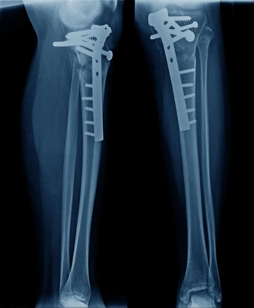 Complex Trauma Surgery Treatment in Moshi – Specialized Orthopedic Care for Severe Injuries