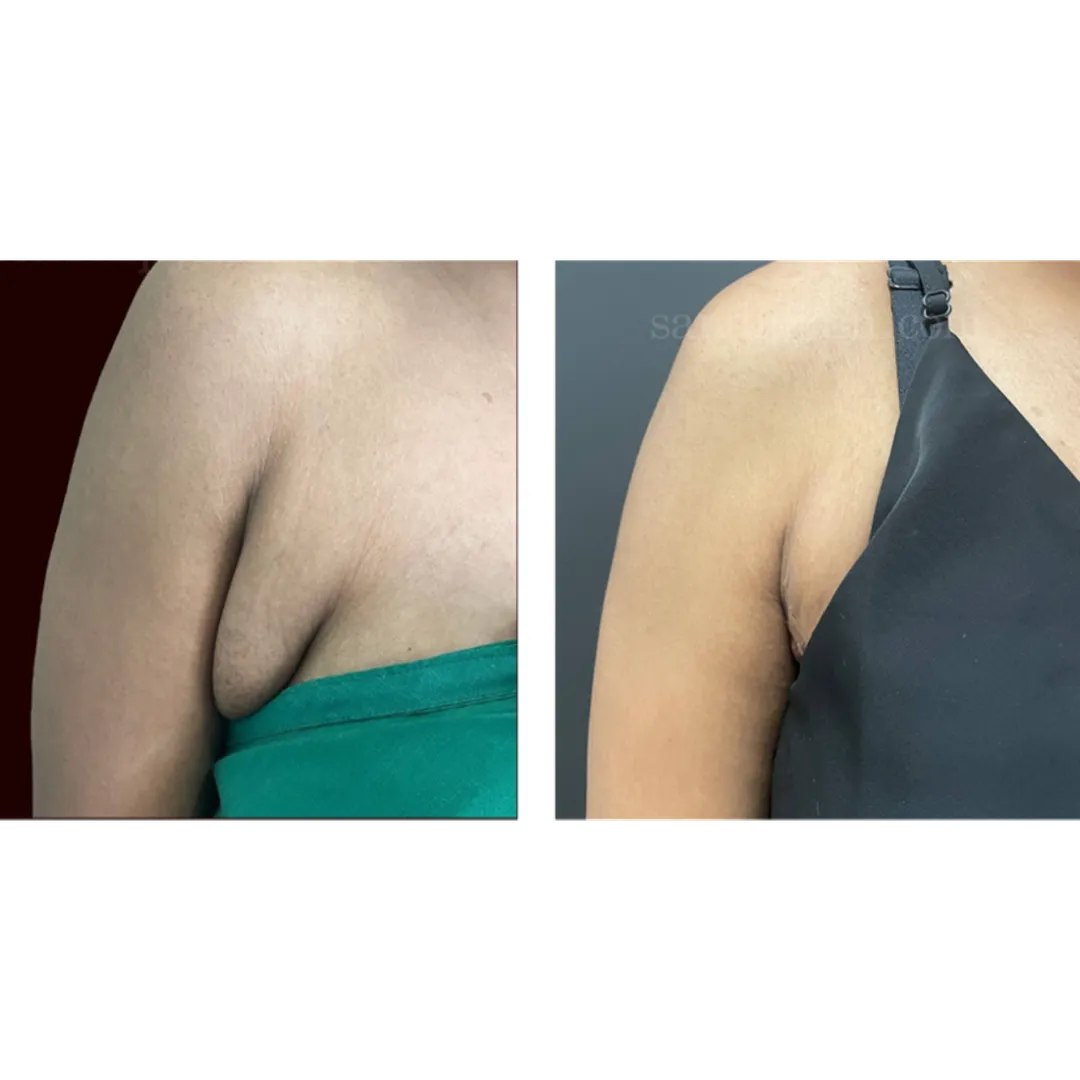 Axillary Breast Swelling Treatment in Andheri, Mumbai | Underarm Breast Tissue Removal