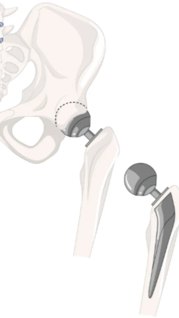 Hip Replacement Surgeon in Pune β Restoring Mobility for Better Living