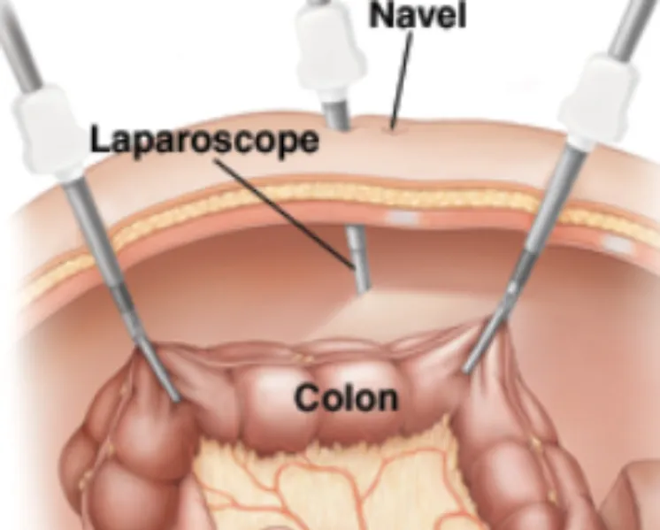 Laparoscopic Colon Surgery in Thane – Advanced Minimally Invasive Care for Colon Disorders