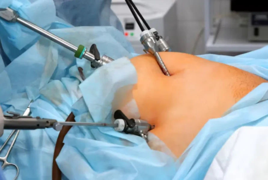 Laparoscopic Sleeve Gastrectomy Procedure in Worli – A Minimally Invasive Path Toward Weight Loss