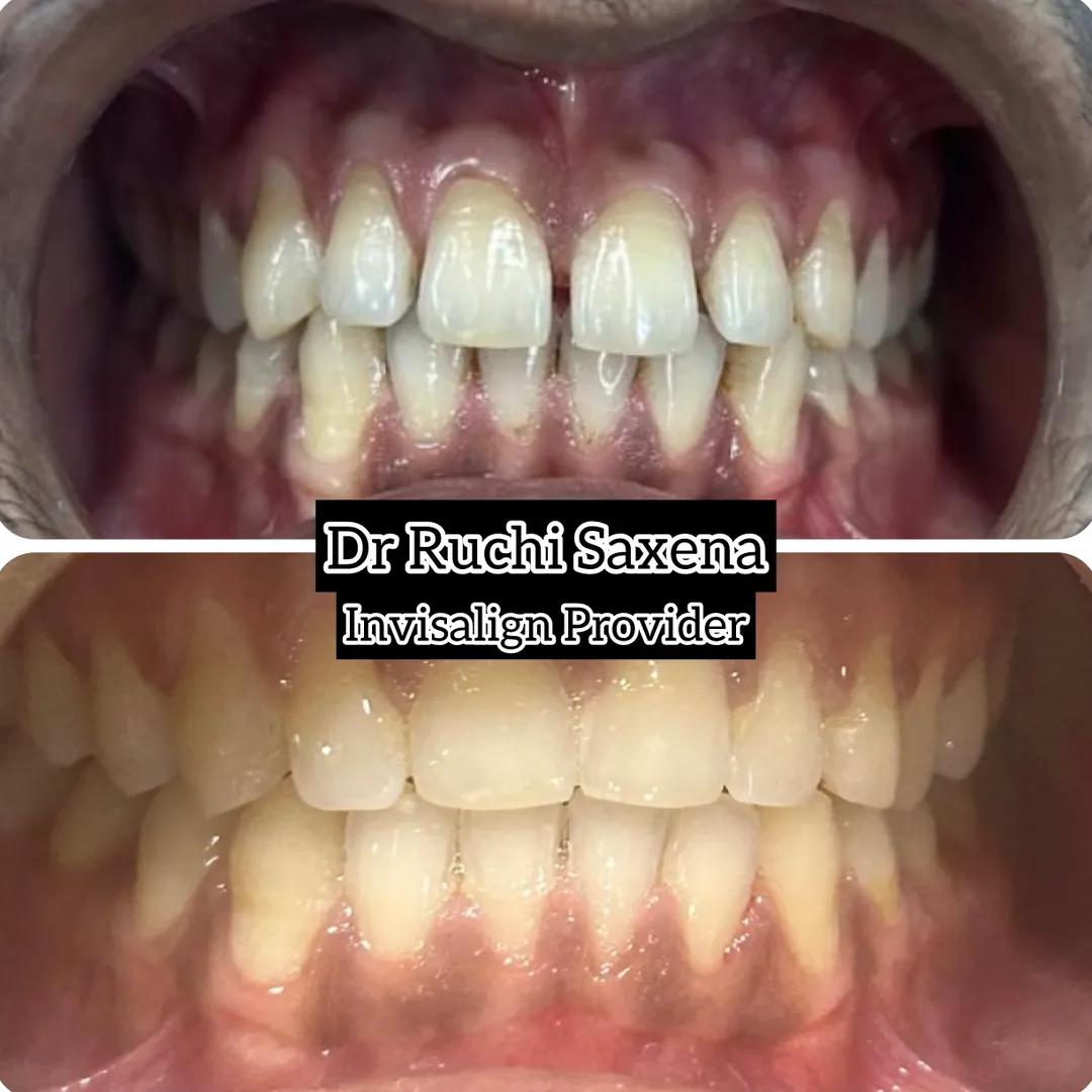 Front Teeth Gap Closure in Noida | Best Orthodontist in Noida | Align & Smile