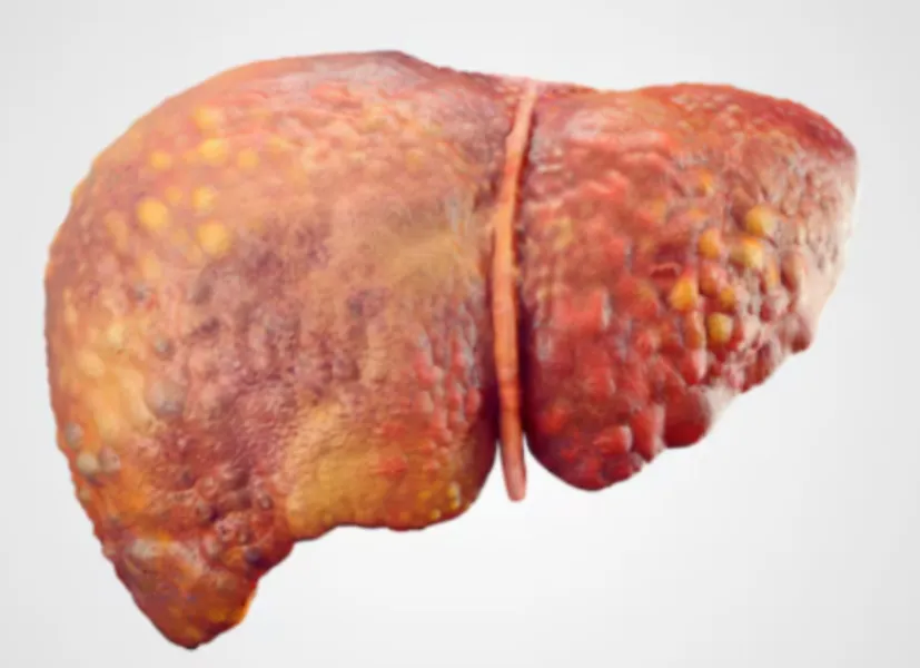 Fatty Liver Treatment in Mumbai Managing a Growing Lifestyle Concern