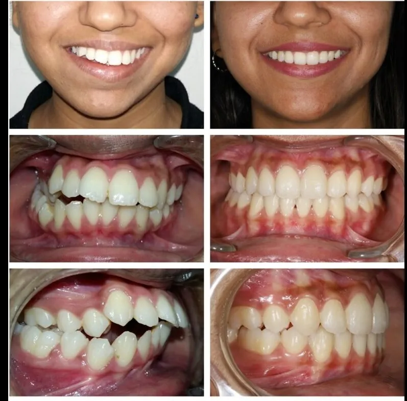 Braces & Invisalign in Gaur City | Orthodontic Treatment – P.D. Dental Clinic