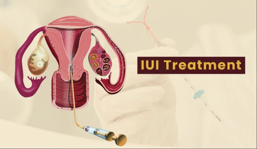 IUI Treatment in Parel: A Simple Yet Effective Solution for Fertility