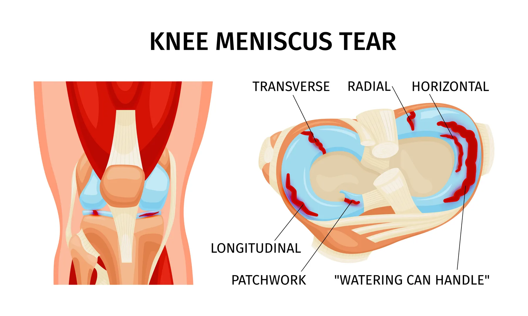 Meniscus Repair Surgery in Delhi Restoring Knee Stability