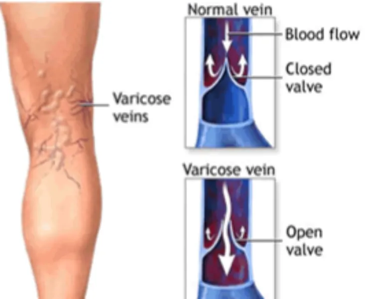 Laparoscopic Vericose Vein Ligation Surgery in Thane – Modern Surgical Treatment for Healthy Leg Ci