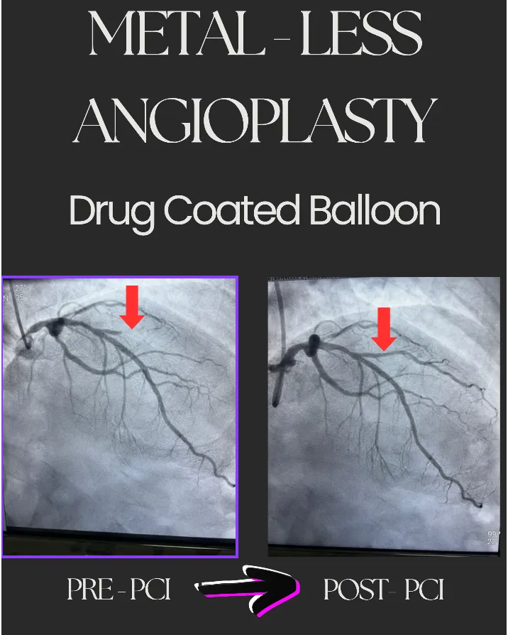 ❤️ Heart Attack Treatment in Young Patients: Is There an Alternative to Stents?