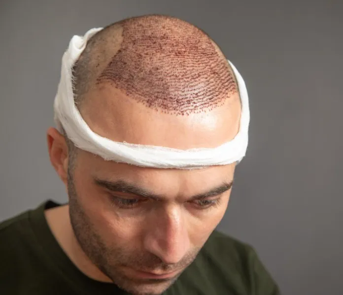 Hair Transplantation in Pune for Advanced Hair Loss and Thinning Areas