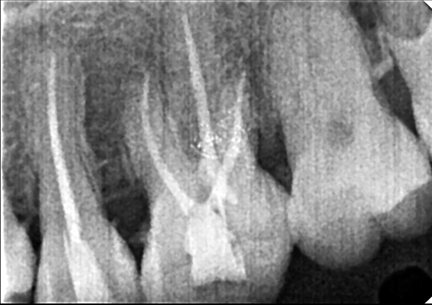Root Canal Treatment in Thane (Nitin Company Area): Cost, Procedure & Recovery Time Explained