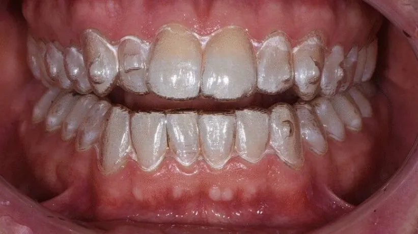 When Do You Need Clear Aligners? Signs Patients in Thane (Nitin Company Area) Should Not Ignore