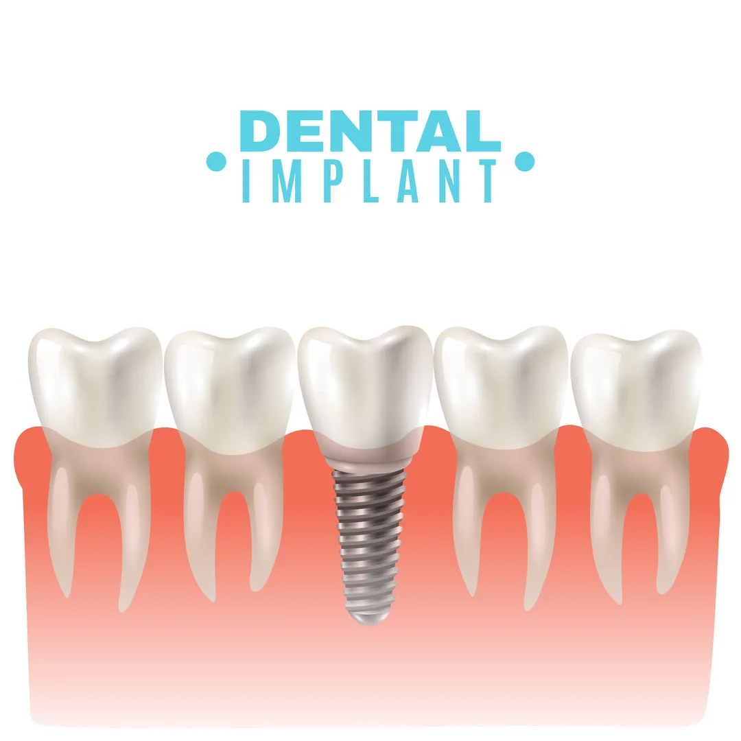 Affordable Dental Implant Clinic in Dwarka A Practical Step Towards Confident Smiles