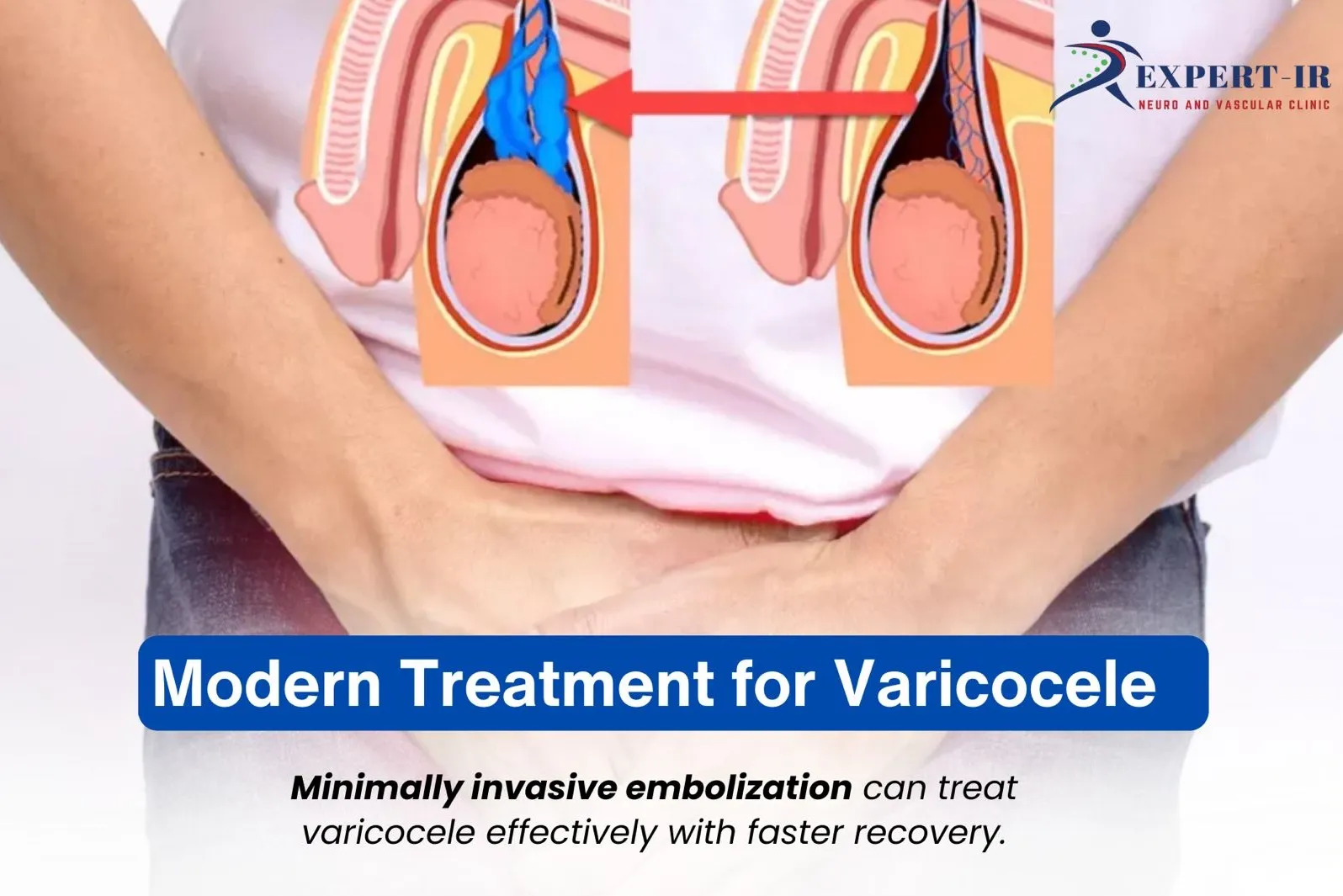 Modern Treatment Options for Varicocele