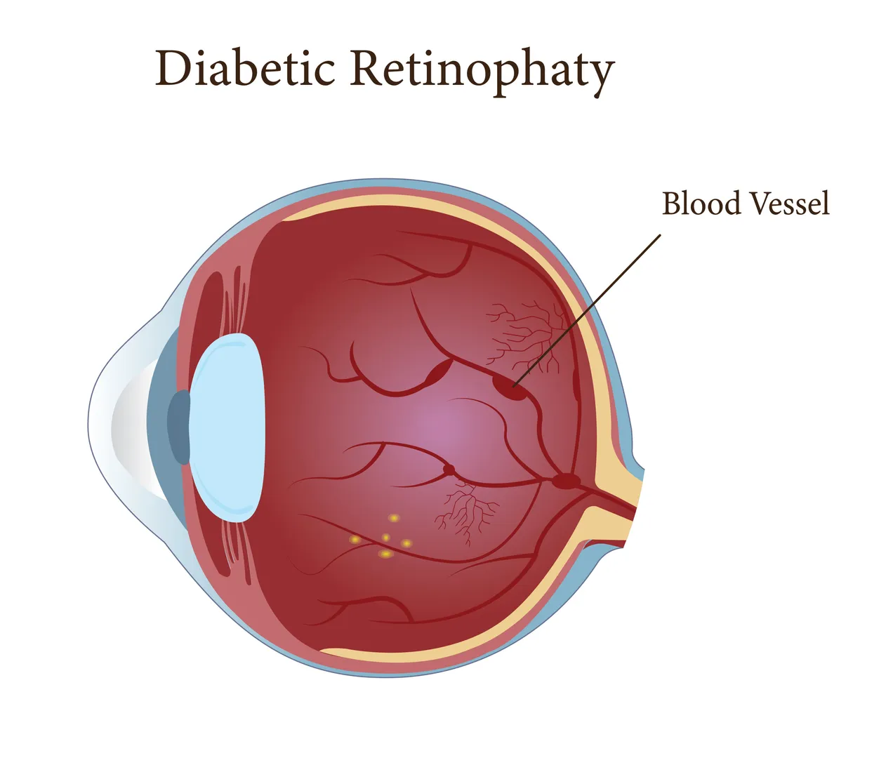 Diabetic Retinopathy Treatment in Belapur Safeguarding Your Vision with Early Attention